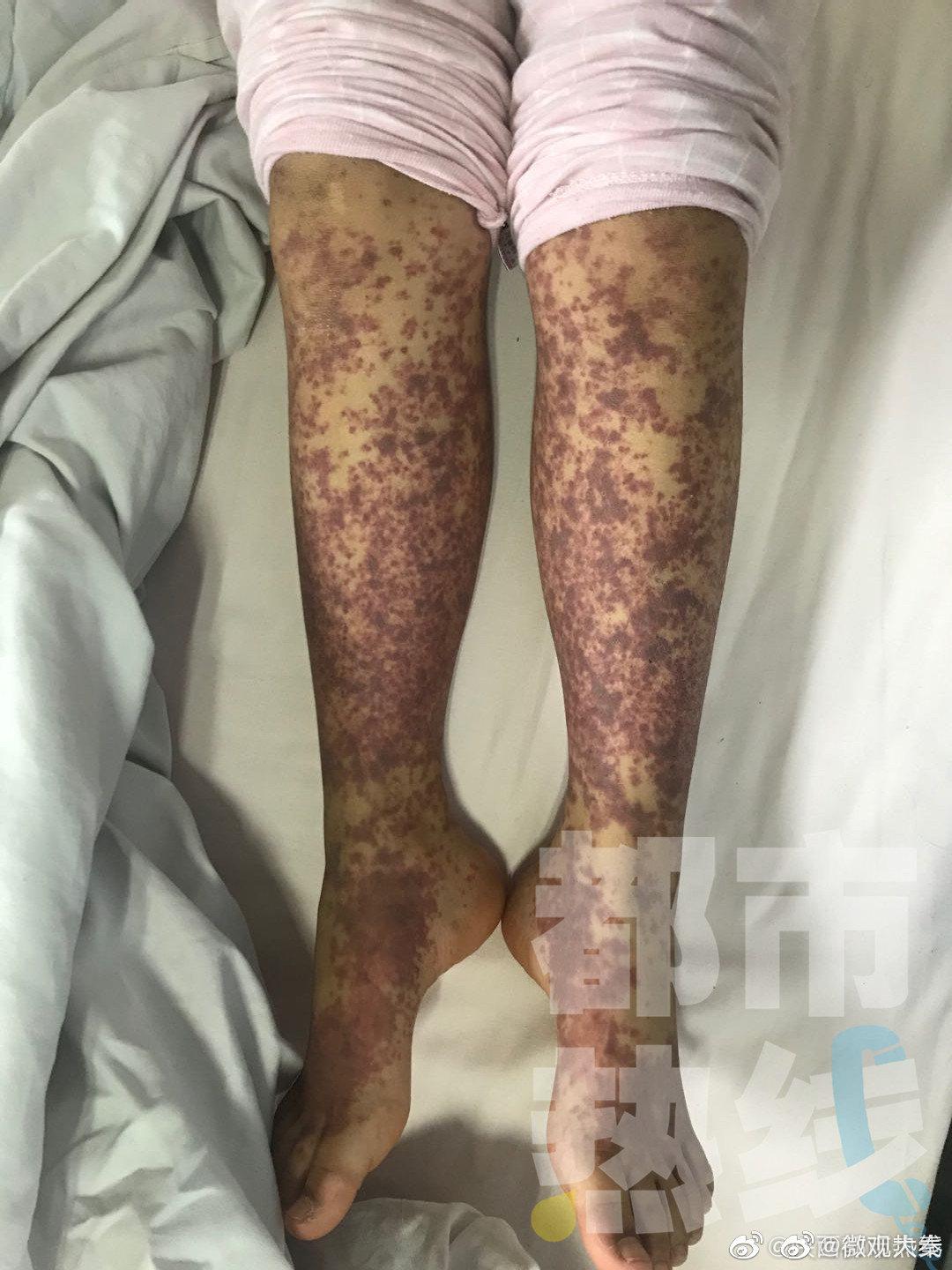 西安一女孩吃烤鱿鱼吃出紫癜 医生:紫癜患者远离海鲜产品|西安|过敏性