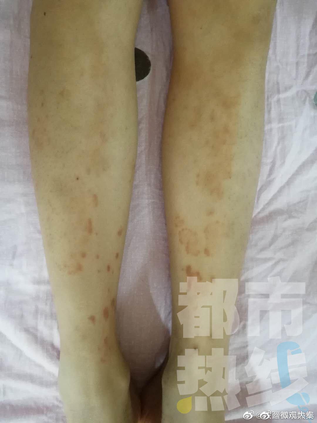 西安一女孩吃烤鱿鱼吃出紫癜 医生:紫癜患者远离海鲜产品|西安|过敏性