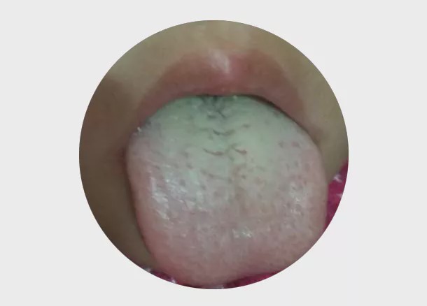 小儿推拿杨晓:看舌苔了解孩子健康,舌诊知识快来了解
