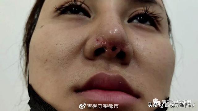 长春女子隆鼻后鼻头坏死留下疤痕无法复原