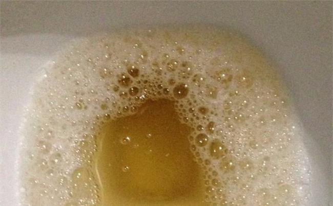 有可能是血糖高了,轻视不得,得控制了|血糖高|糖尿病|血糖_新浪新闻