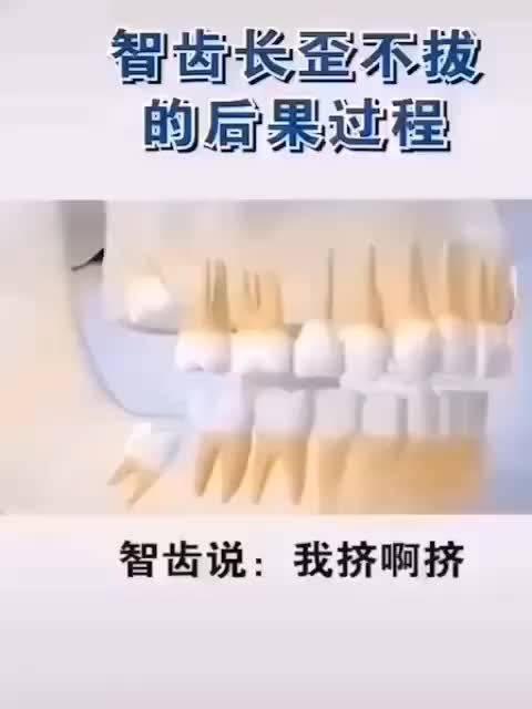智齿长歪不拔的后果 智齿长歪不拔的后果