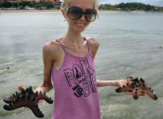 世界上最瘦的人,因减肥患厌食症生不如死(仅重20公斤)__财经头条