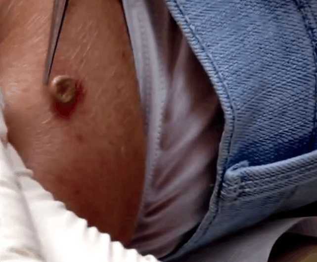 叫蜱虫,是吸血虫子,在男子睡觉时钻进了他的身体