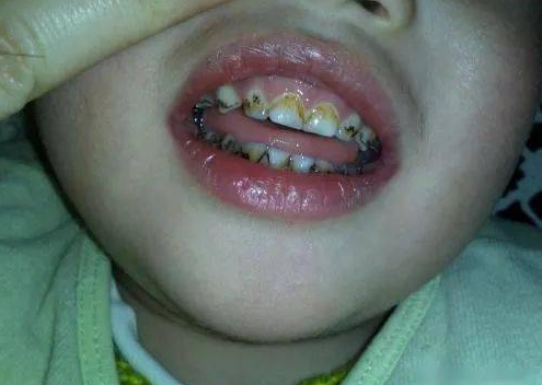 宝宝的乳牙坏了没关系反正迟早要换牙齿的真的是这样的么