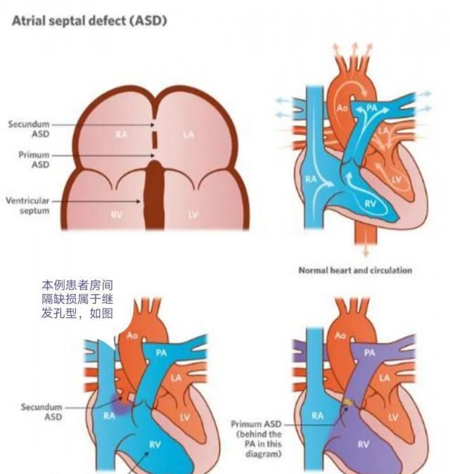 姑娘从小体弱没力气,17岁查出真相,父母懵了|房间隔缺损|肺动脉高压