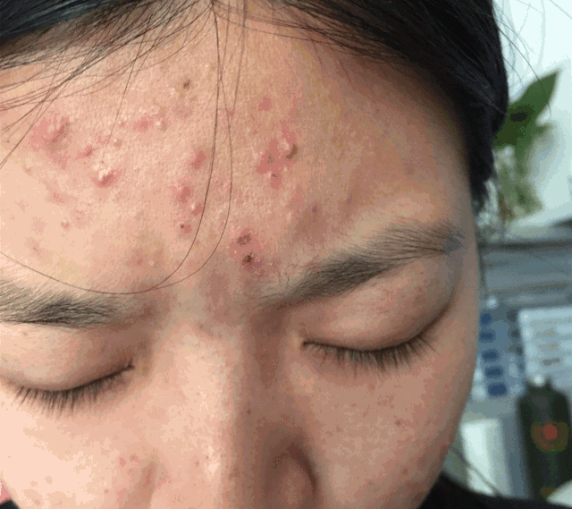 原来女人长黑头vs不长黑头差距这么大.