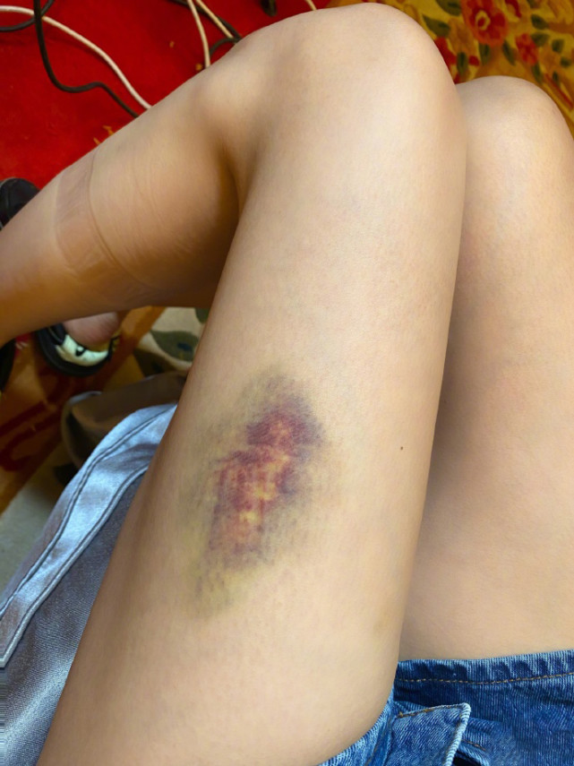 女生脚膝盖受伤图片图片