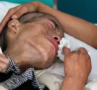 肝癌,那么所有的治疗都是效果很差的了,这时候的目的主要是减轻症状