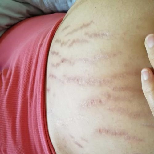 孕妈都讨厌的"花肚皮",这五类人却总能躲过,你是其中之一吗|妊娠纹