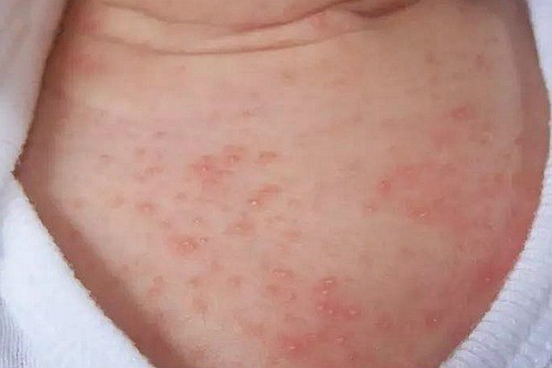 小儿推拿杨晓:夏季来袭,宝宝长痱子怎么办?如何预防护理?