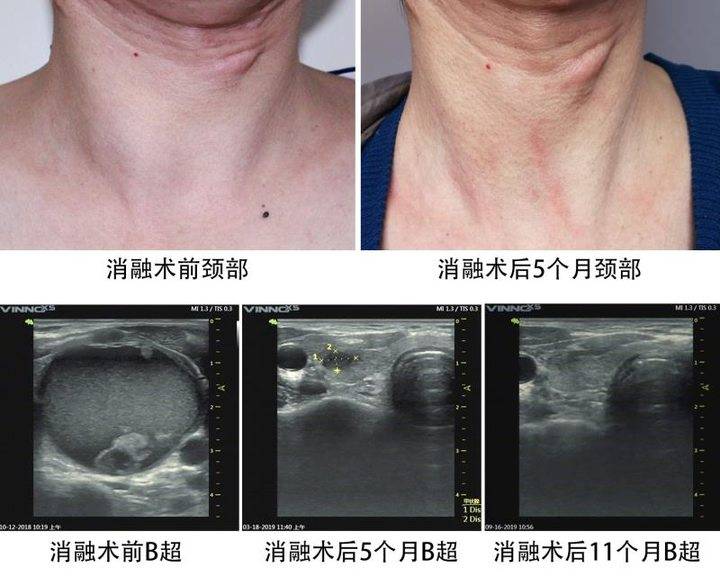 甲状腺微创治理的新方式 专家详解微波消融术