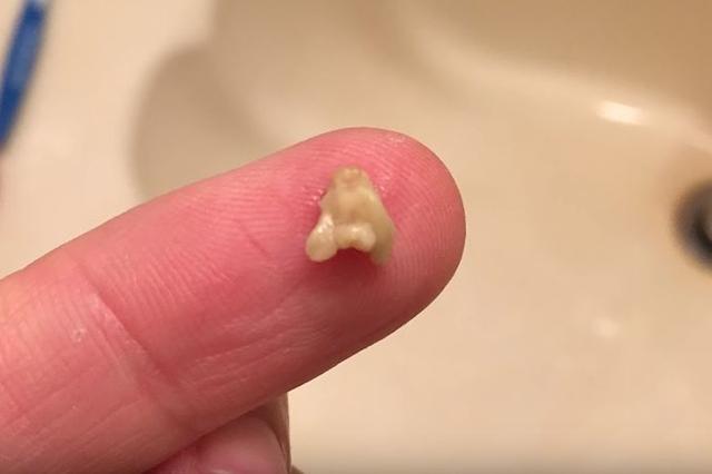 经过医生的诊断后,从孩子的嘴巴里取出了一个小颗粒状的东西.