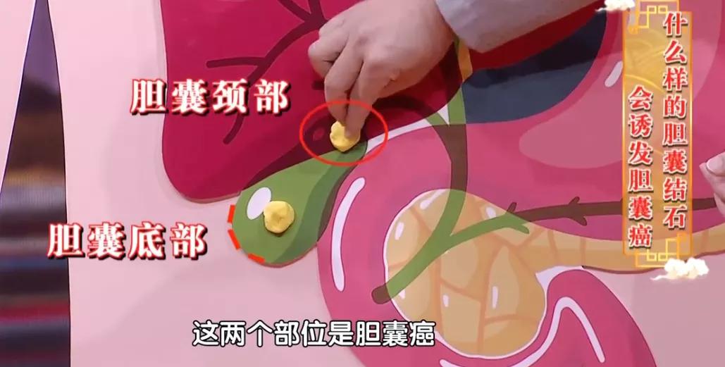 胆囊结石诱发胆囊的肿瘤,最常见的是在胆囊底部和胆囊颈部这两个位置