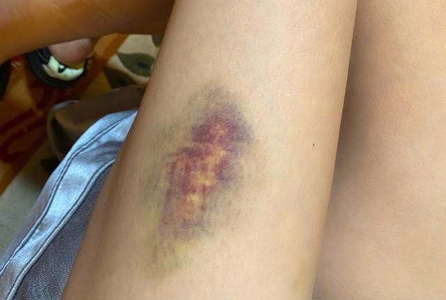 沈梦辰晒大腿伤痕第一个回复的却不是男友不怕杜海涛吃醋吗