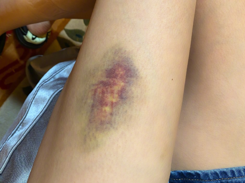 沈梦辰纤细的大腿上有一大片淤青的痕迹,看起来损伤的面积还是很大的