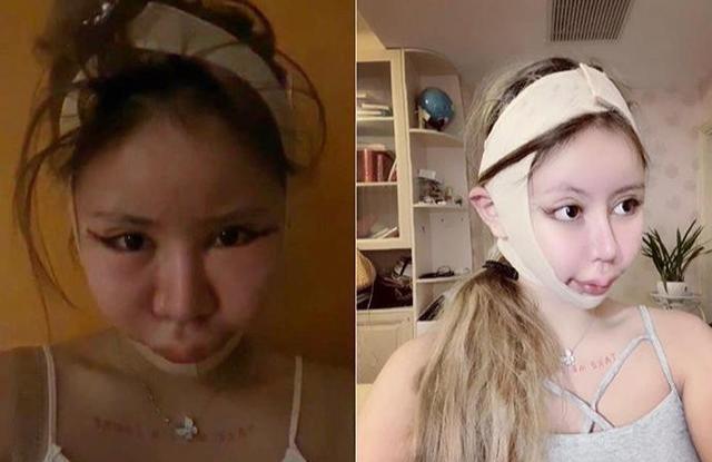 网红整容成瘾13岁起整容100次!网友:你的才艺就是脸吓人