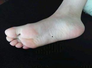 正文       在痣要学上说,左脚底有痣是权,右脚底有痣是财,在右脚底下