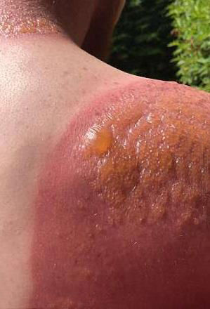 他对着镜子仔细一看,原来他已经被晒伤了,手臂的部分甚至还起了水泡