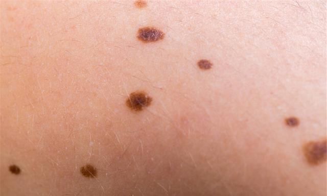 家长们要多留个心眼|血管瘤|红点|毛细血管_新浪新闻