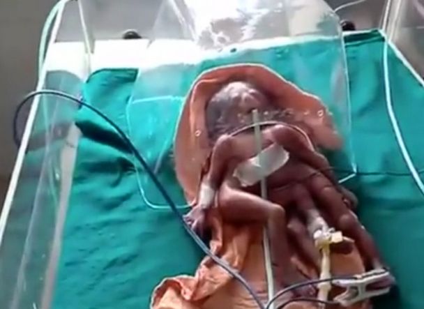 女子怀孕10月,生下4手4脚异形婴儿,医生却这样解释!