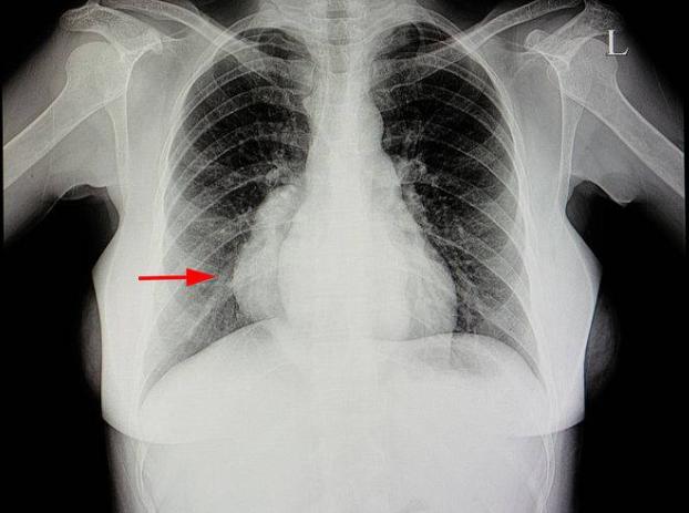 肺癌容易与4种疾病混淆,做好区分,尽早治疗很重要!