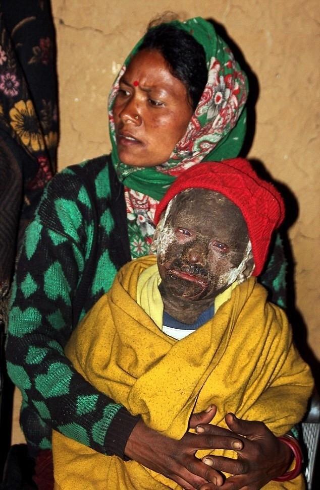 11岁男孩患罕见怪病全球不到10例没钱医治将变石头人