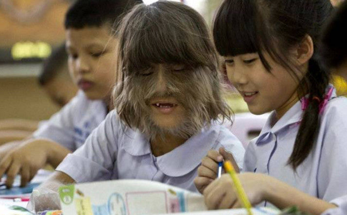 泰国六岁小女孩患上怪病满脸汗毛成灾变怪物被称现实版孙猴子