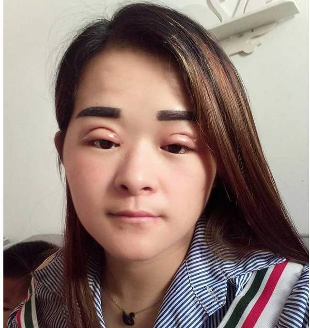 女朋友花了一万块,做的双眼皮,一个星期之后,朋友看到都傻眼了