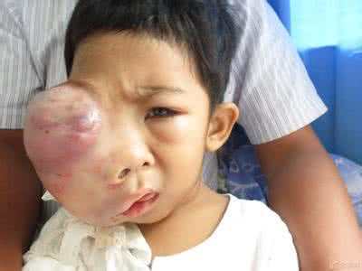 视网膜母细胞瘤|视神经|爱丽_新浪新闻