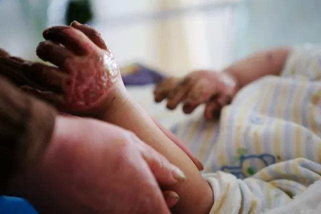 当时现场一共有7个人被烧伤(其中有3个是小孩,年龄分别为10岁,9