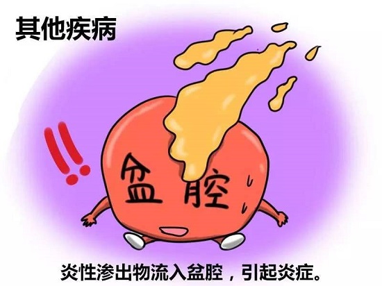 了解这4个情况,3个为什么,2个方案,轻松解决盆腔炎!