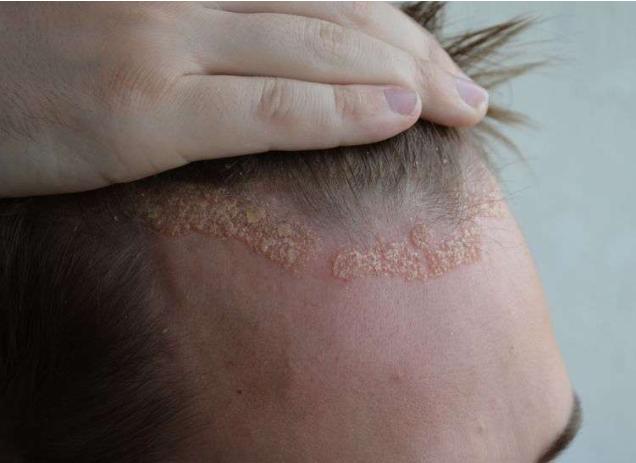 头皮反复出现疙瘩可能是这3种疾病在捣乱及时检查别忽视