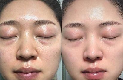 夏天容易油腻毛孔粗试试能量小黑膜让肌肤水润嘭弹超净爽