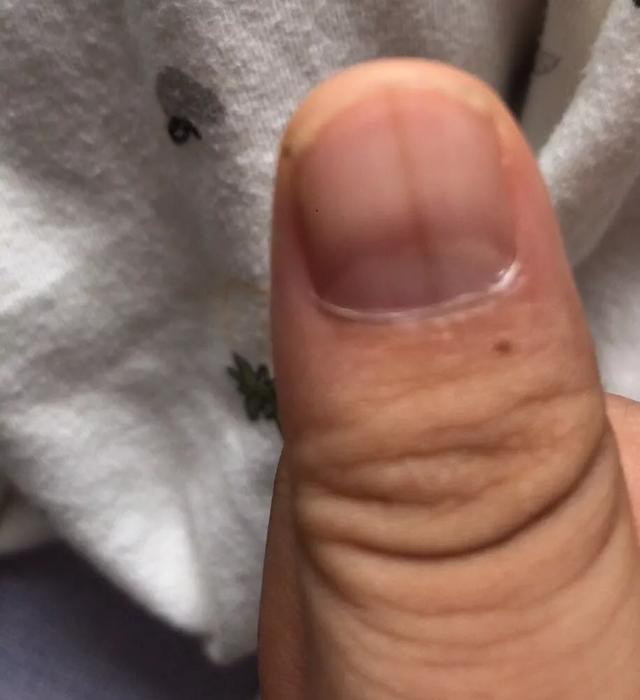 指甲|竖纹|黑线_新浪新闻