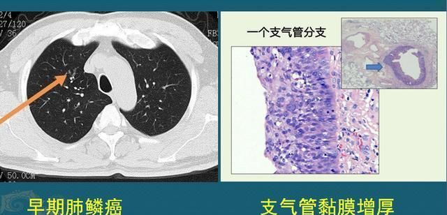 肺鳞癌是怎么发生的怎样早期发现医生教你看ct片