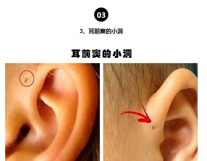 如果你耳朵的突出部分让你看起来像个精灵,那么你就有先天性达尔文