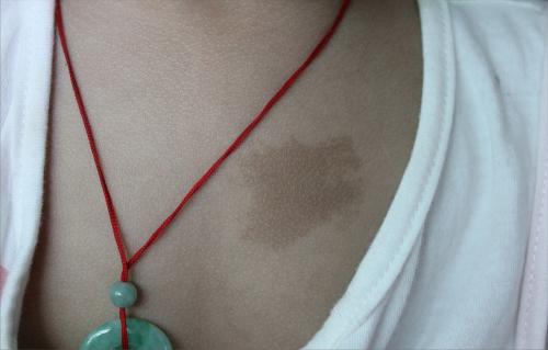 孕妈这3类习惯,容易导致宝宝被打"印记"|胎记|宝宝|蒙古斑_新浪新闻