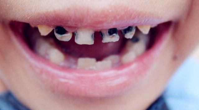 4岁孩子满嘴"黑牙",医生提醒:如果孩子有这种习惯,尽早改掉|牙齿|家长