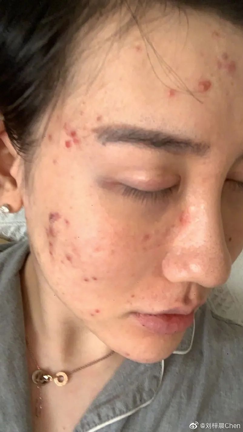 刘梓晨晒毁容照,称正经历地狱般生活,他这张脸还能重生吗?
