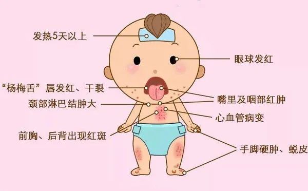 寿光市妇幼保健院成功诊治不完全型川崎病