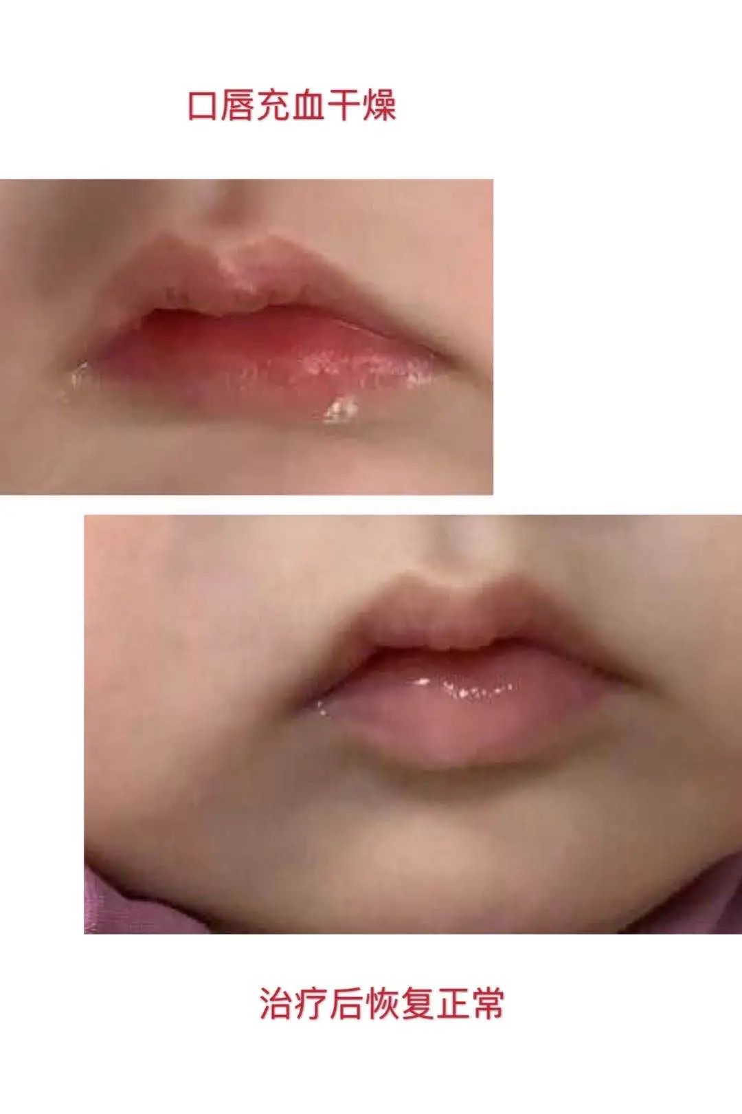 寿光市妇幼保健院成功诊治不完全型川崎病