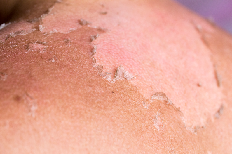 会做晒后修复你还能抢救一下!