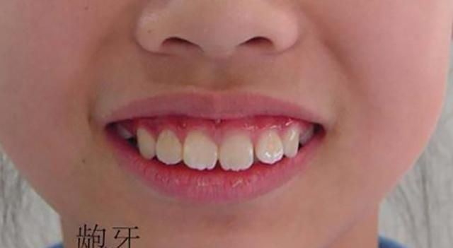 吮吸手指不恰当地说,就是脸变长了(鞋拔子脸),牙凸起来了(龅牙),下巴