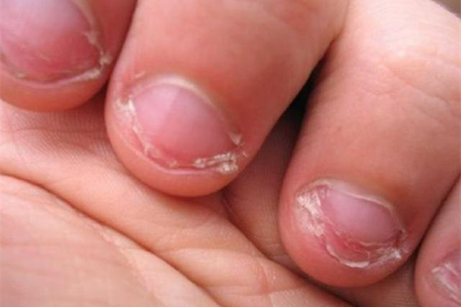 从小啃指甲的孩子长大会变成什么样医生难逃这两种结局