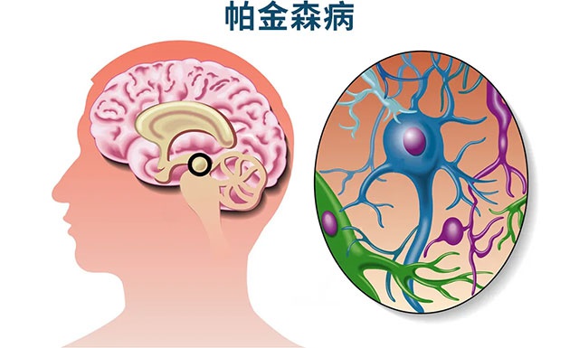 帕金森|症状|患者_新浪新闻