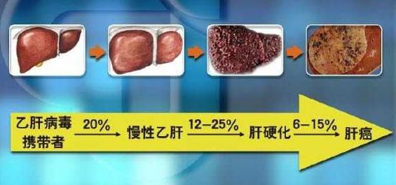 乙肝最可怕的不是进展为肝癌而是这两点医生预防大于治疗