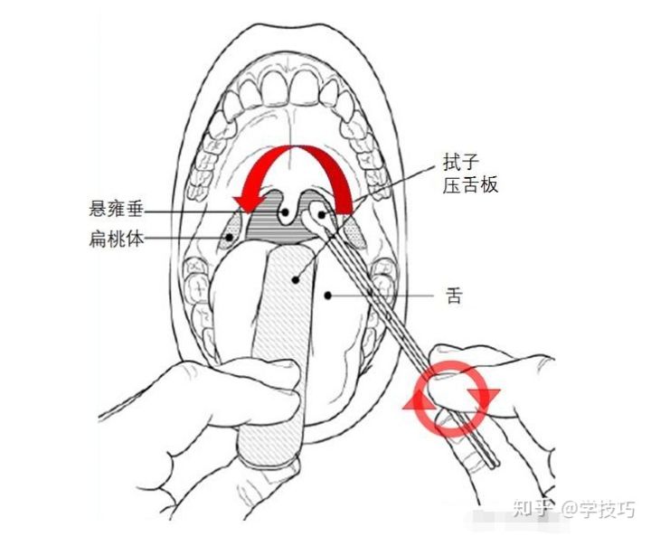 先看看咽拭子和鼻拭子的采样对比图:核酸检测分咽拭子和鼻拭子两种