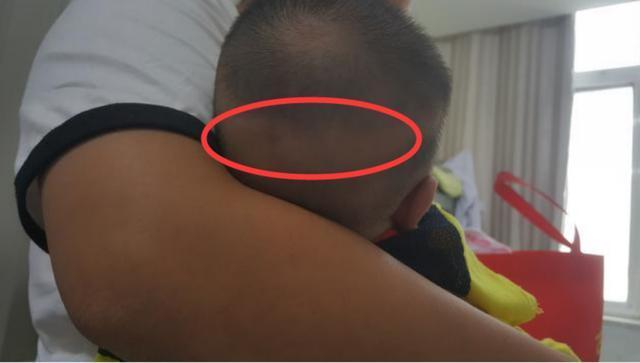 婴儿缺钙头型图片图片