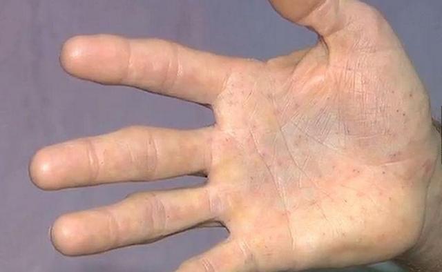 男子把扎进手掌的400多根刺拔出,手掌上全是密密麻麻的小孔.